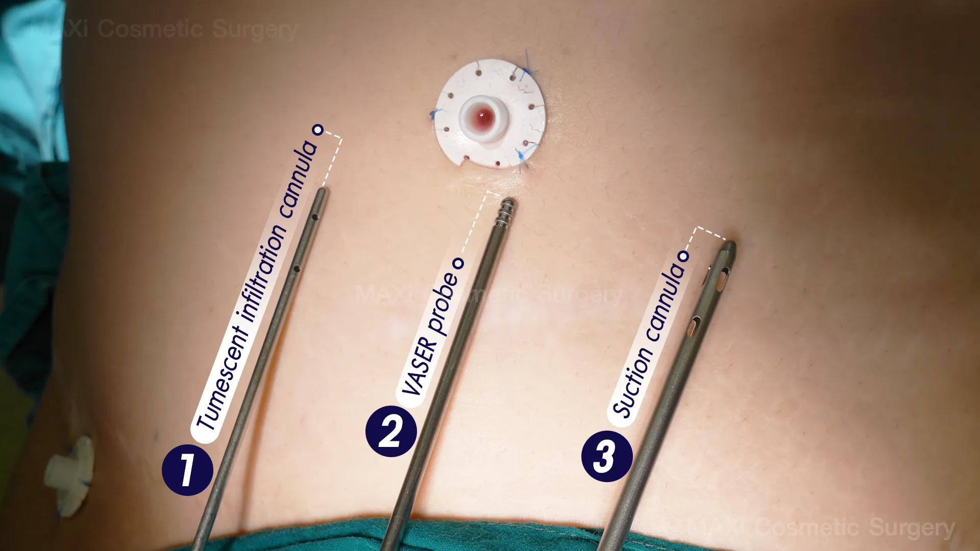 Close-up of VASER liposuction procedure highlighting fat removal and skin tightening benefits, Dr.kanit Vaser Liposuction in thailand