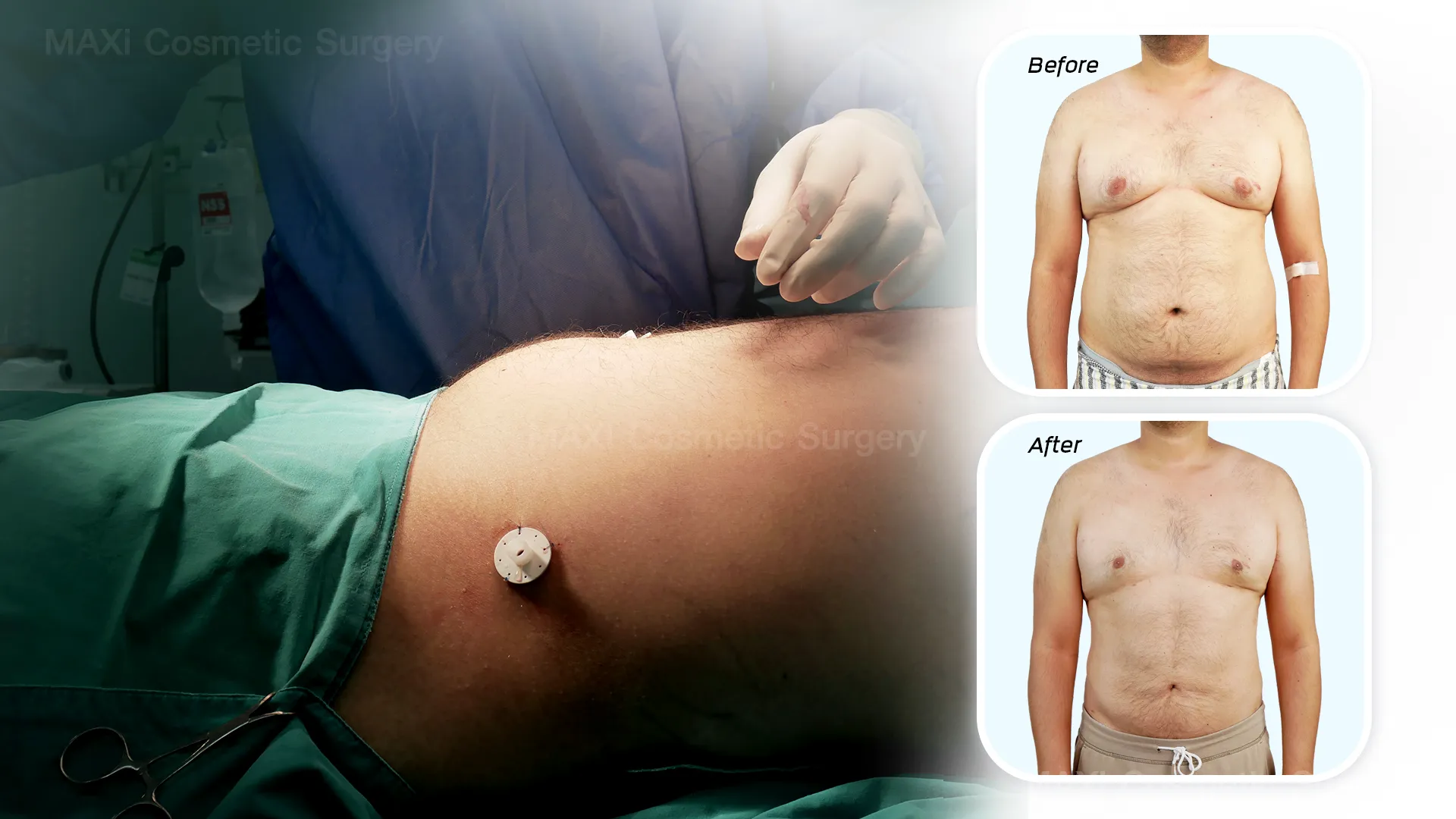 Before and after VASER liposuction on abdomen and flanks for body contouring results in Thailand, Dr.kanit Vaser Liposuction in thailand