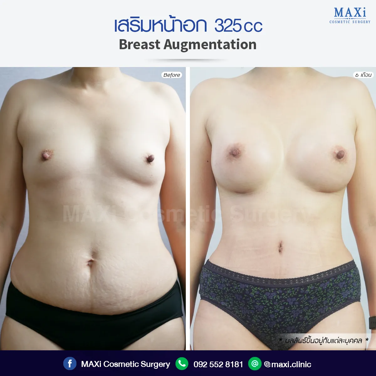 ก่อนและหลังเสริมหน้าอก ขนาดพอดีตัว เสริมนมทรงสวยได้สัดส่วน