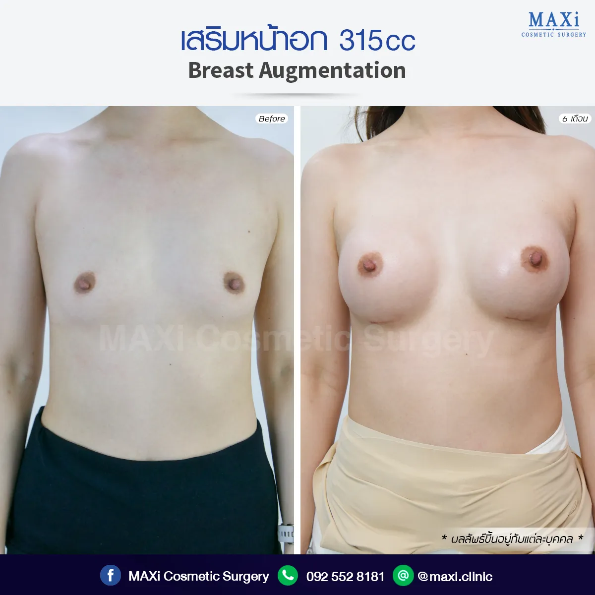 เปรียบเทียบผลลัพธ์ก่อนหลังเสริมหน้าอก เพิ่มความมั่นใจให้รูปร่างดูมีสัดส่วน