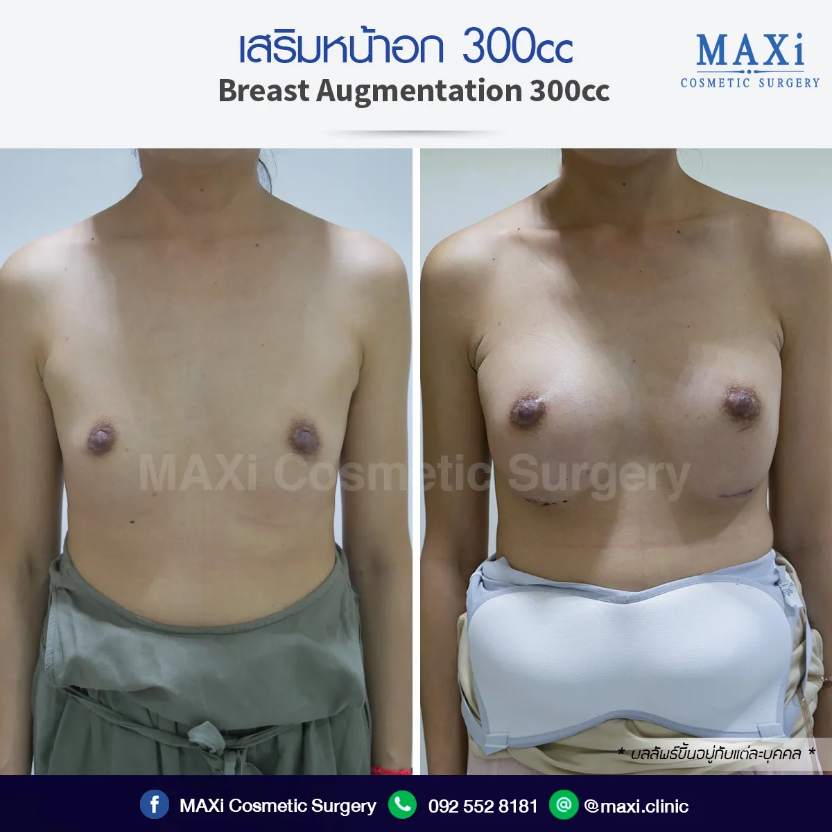 ภาพก่อนและหลังเสริมหน้าอก ผลลัพธ์การเสริมนมทรงสวยเป็นธรรมชาติ