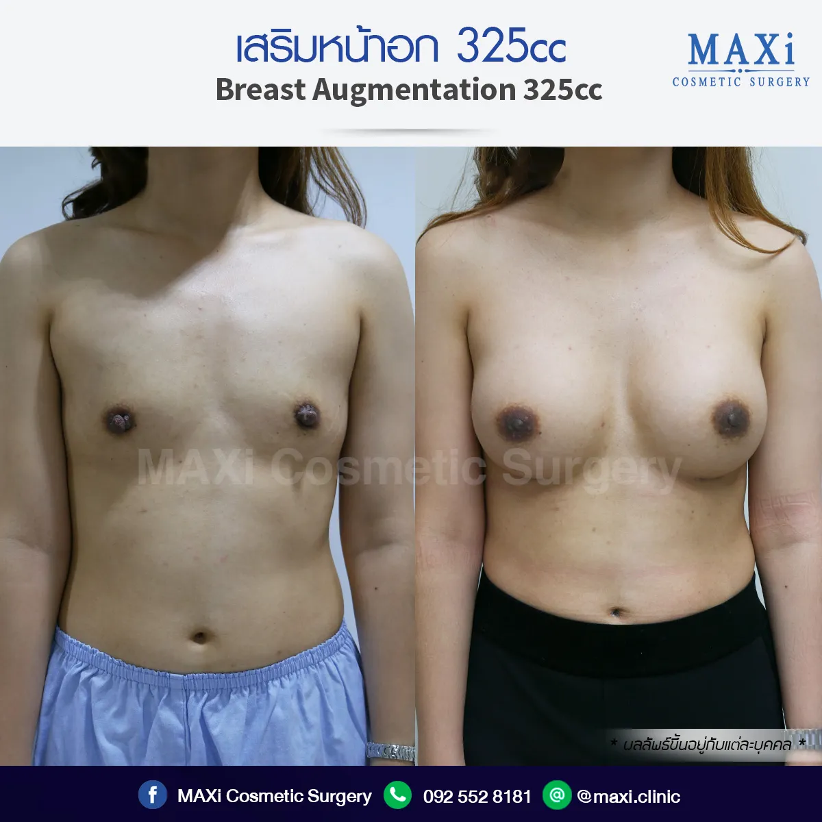 เสริมหน้าอก ปรับขนาดทรงอกให้สวยรับรูปร่าง ภาพก่อนและหลังผ่าตัดเสริมนม
