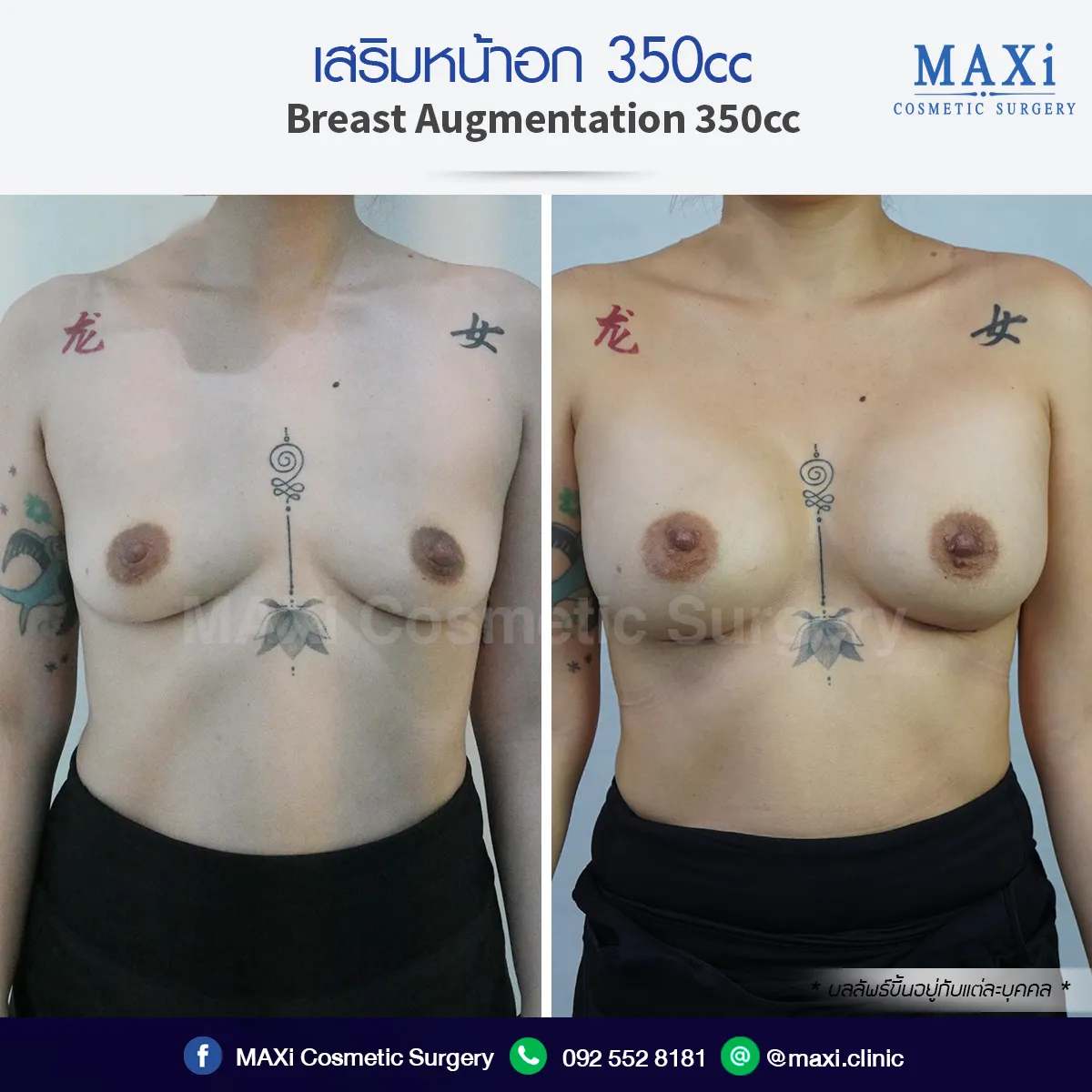 รีวิวก่อนและหลังเสริมนม เสริมหน้าอกทรงสวยได้สัดส่วน โดยศัลยแพทย์เฉพาะทาง