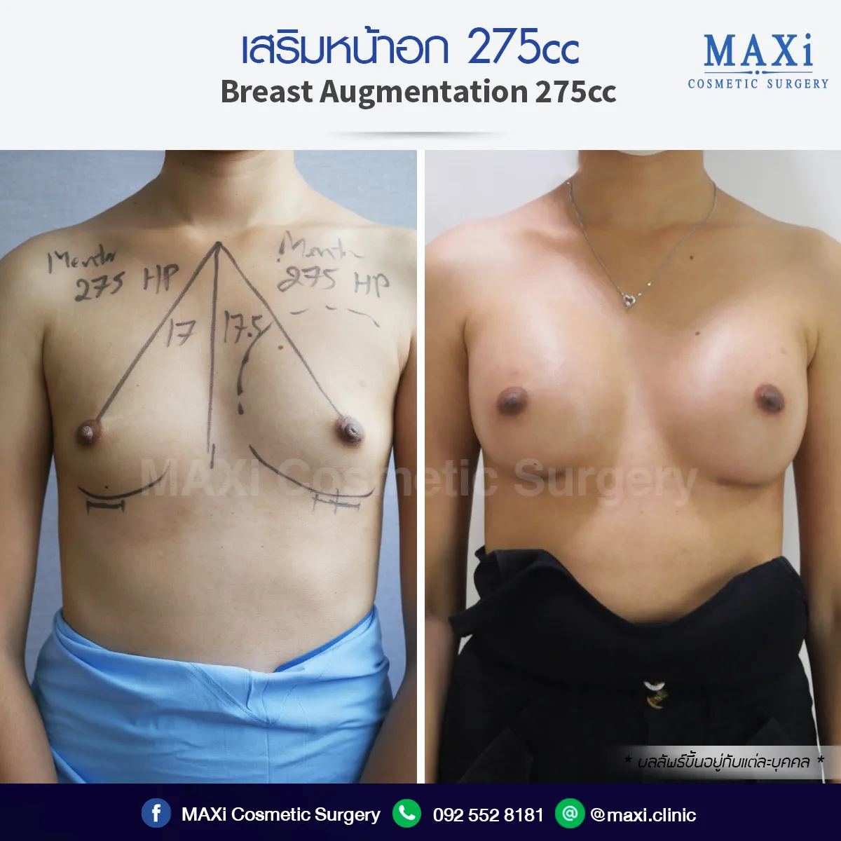 ภาพเปรียบเทียบก่อนและหลังศัลยกรรมเสริมหน้าอก เพื่ออกชิด อวบสวย ดูเป็นธรรมชาติ