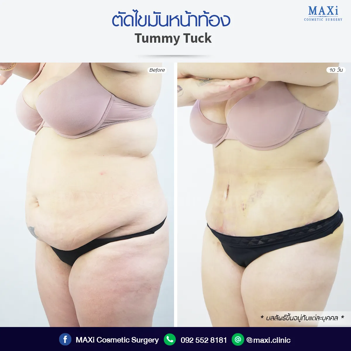 Breast Augmentation surgery result showing natural-looking enhancement and improved body proportions