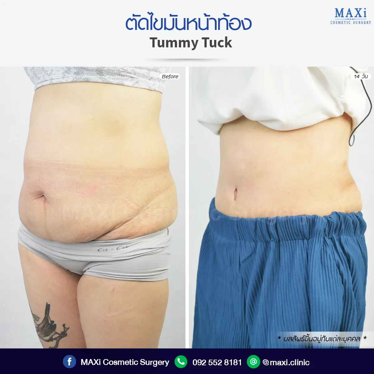 Before and after Breast Augmentation procedure for fuller and symmetrical breasts