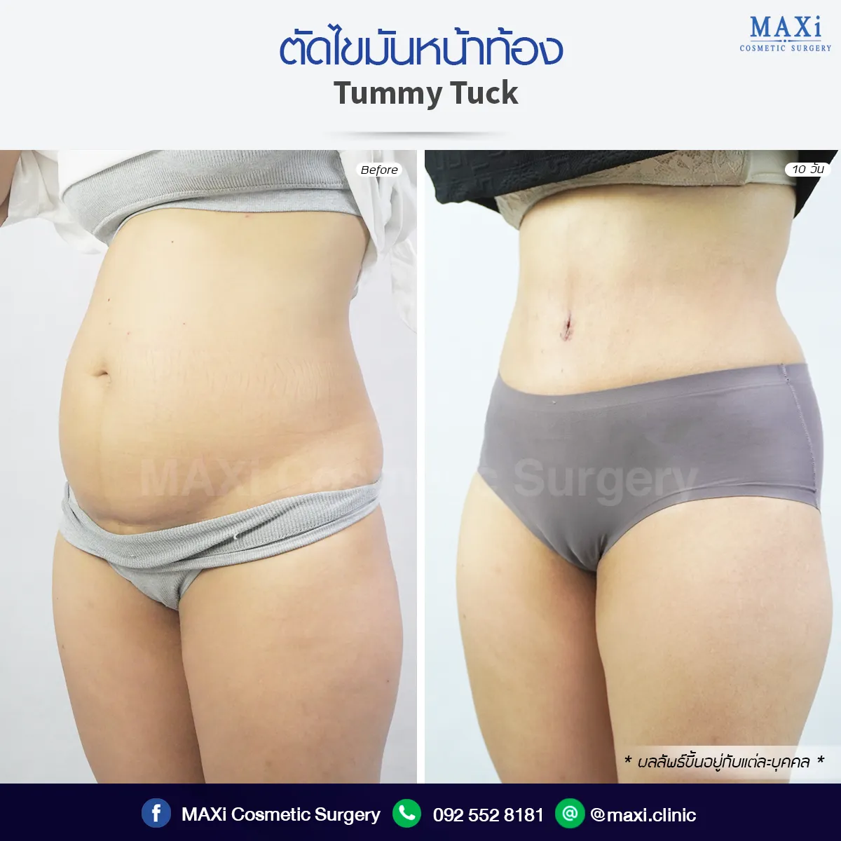 Breast Augmentation at aesthetic clinic for confidence and beautiful contour