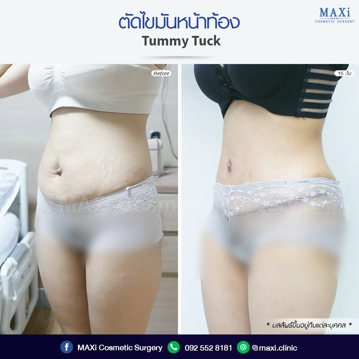 Close-up result of Breast Augmentation showing smooth and balanced shape