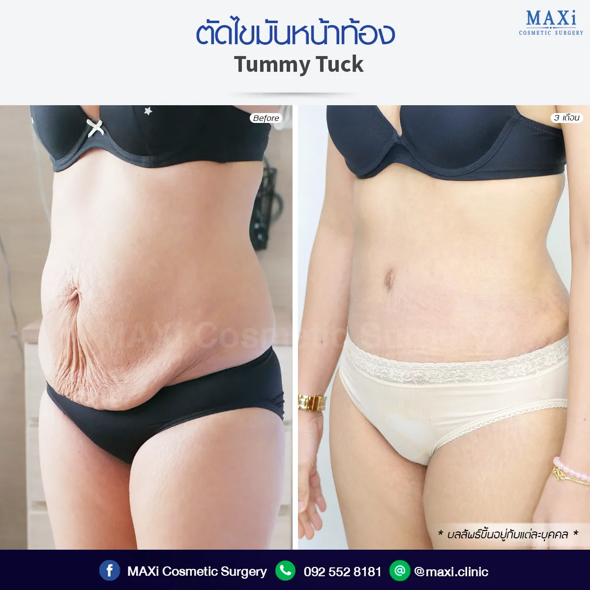 Patient result after Breast Augmentation with natural soft implant technique