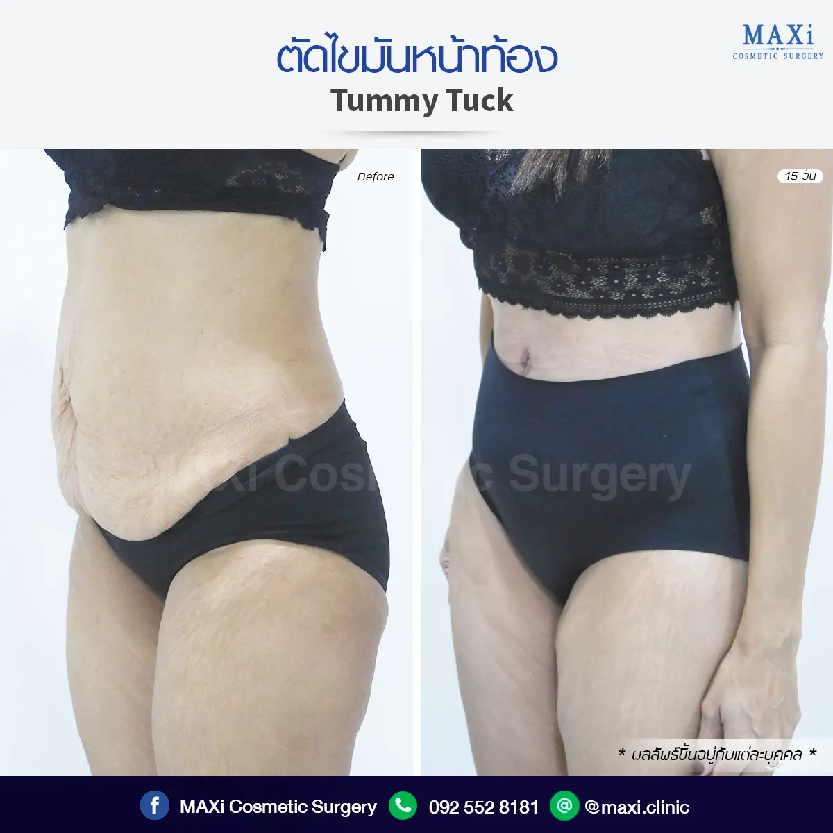 Before and after Breast Augmentation showing fuller, natural-looking breasts