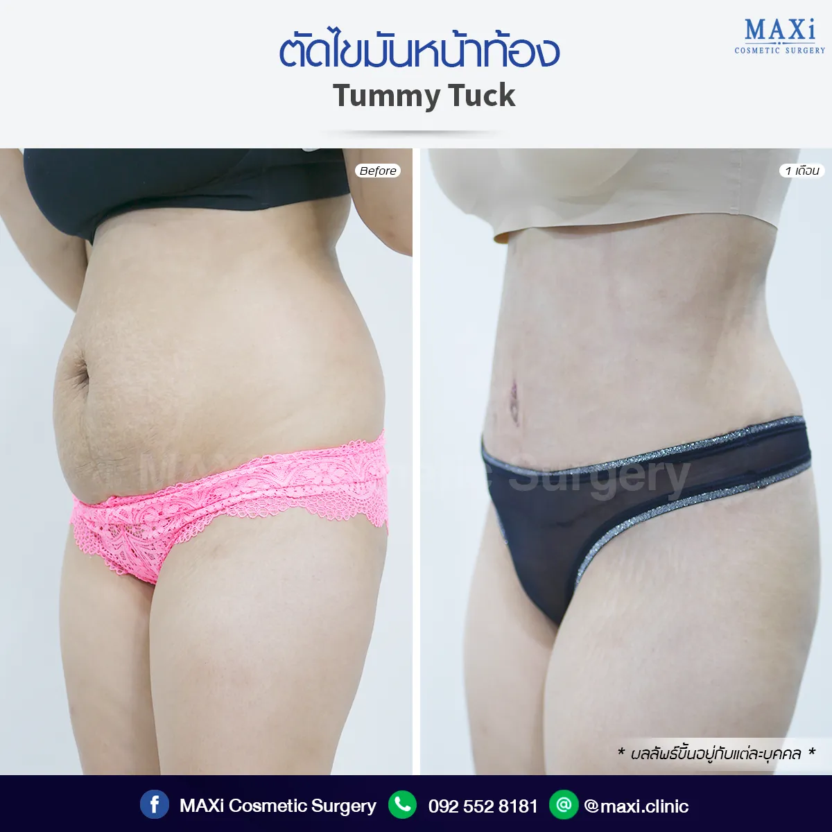 Before and after Breast Augmentation result showing improved body proportion and confidence