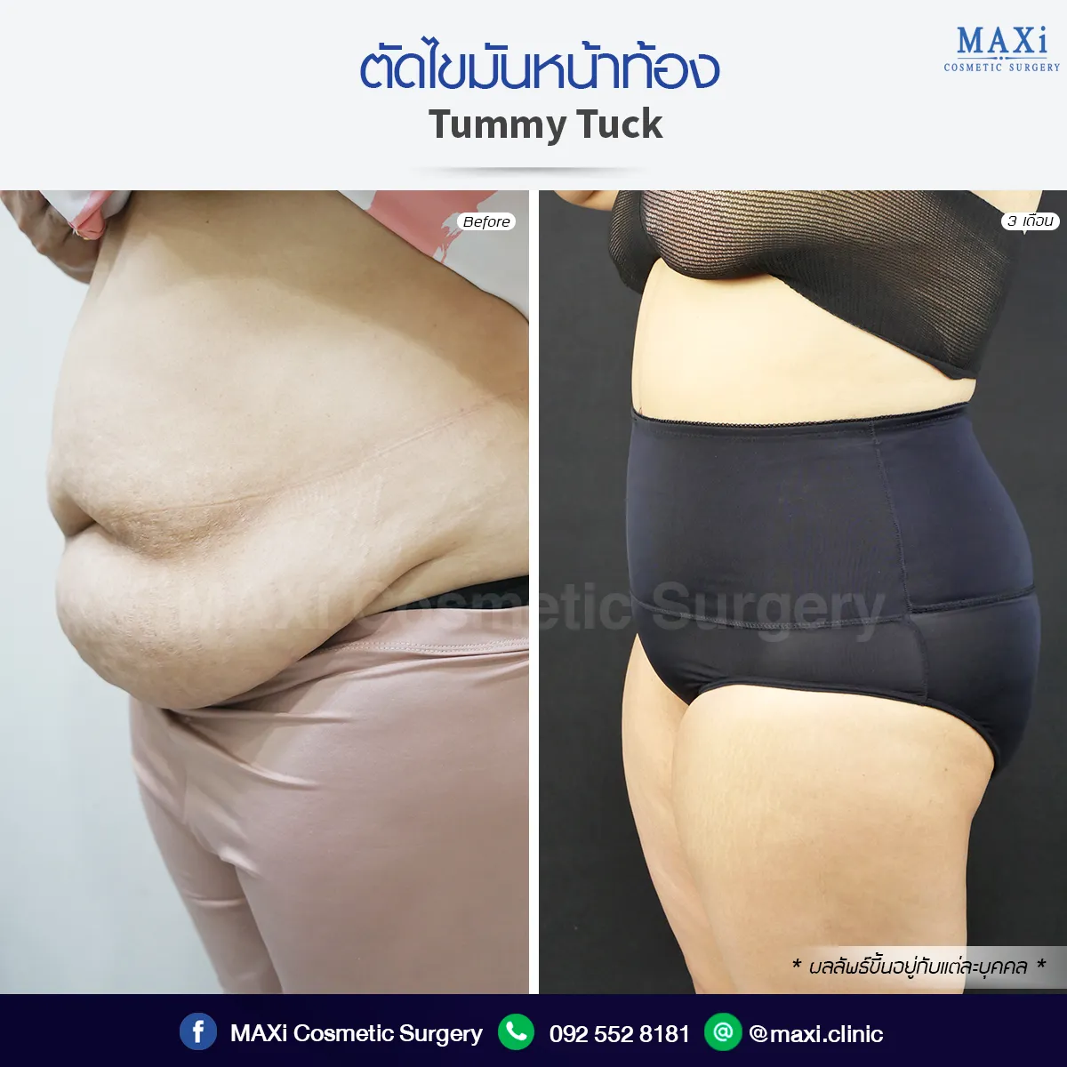 Natural-looking result after Breast Augmentation — before and after comparison