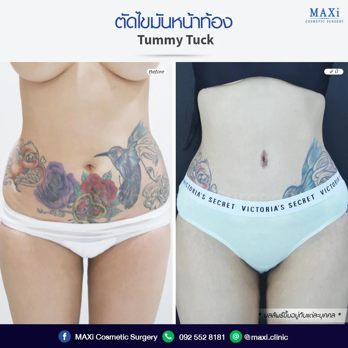 Before and after Breast Augmentation at cosmetic surgery clinic demonstrating beautiful contour