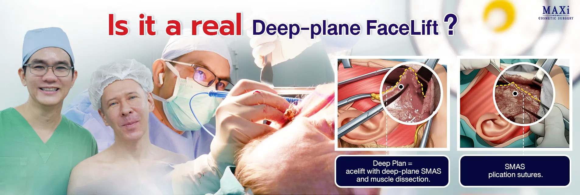 Real Deep Plane Face Lift procedure showing deep-plane SMAS dissection compared with High SMAS facelift technique, performed by experienced facial plastic surgeons to achieve natural face lift results