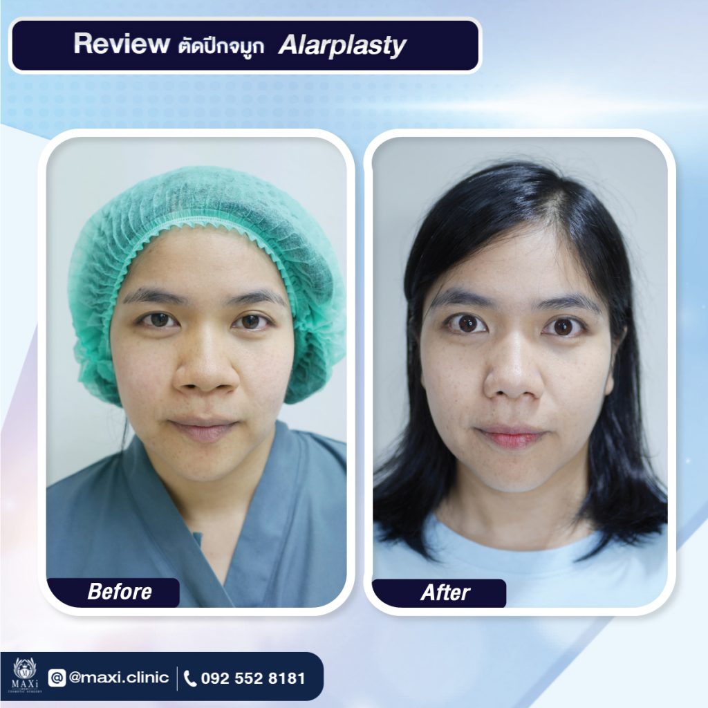 Alarplasty - MAXi Cosmetic Surgery