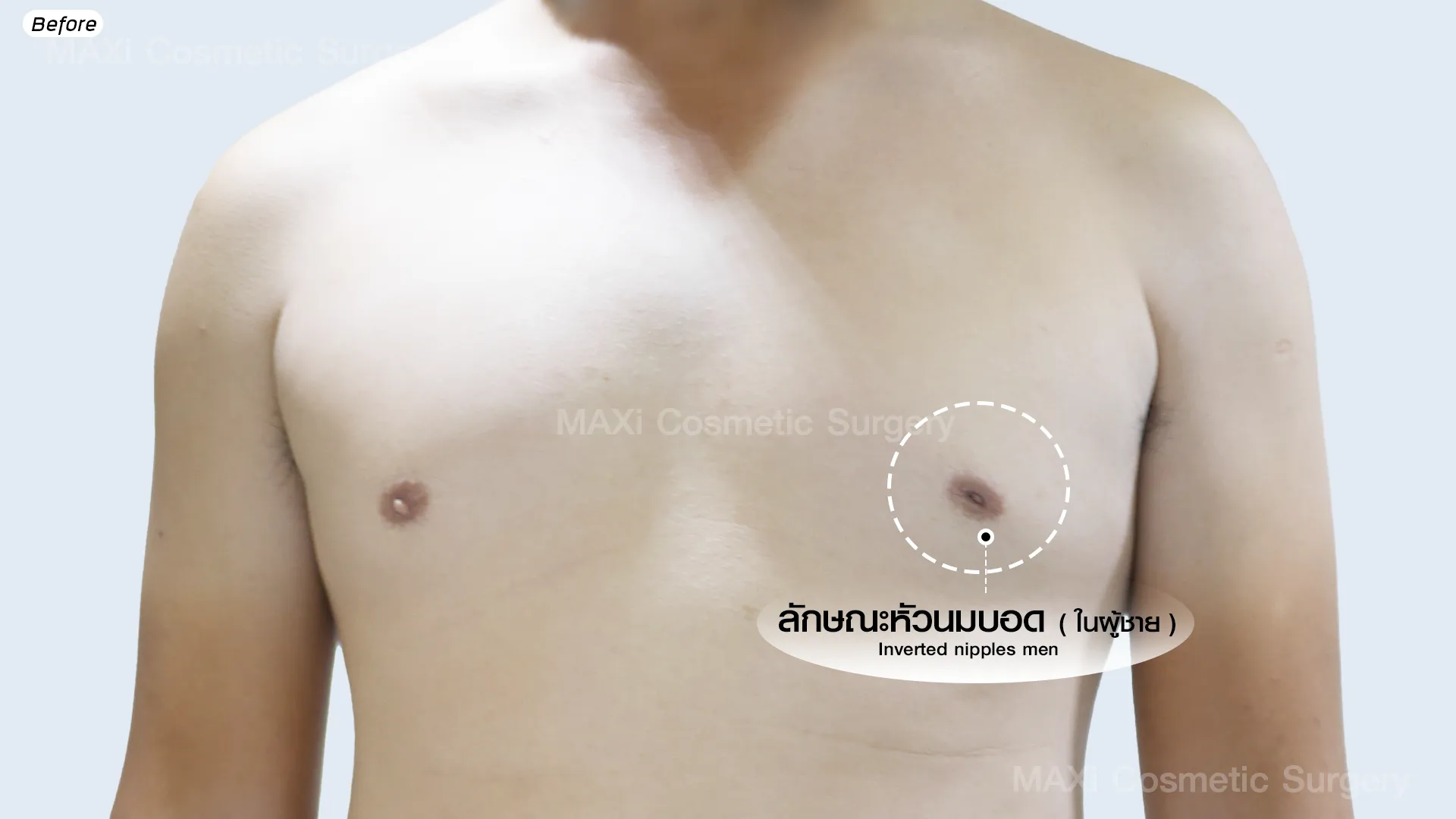 แก้ปัญหาหัวนมบอดในผู้ชาย คืนความมั่นใจในรูปร่าง