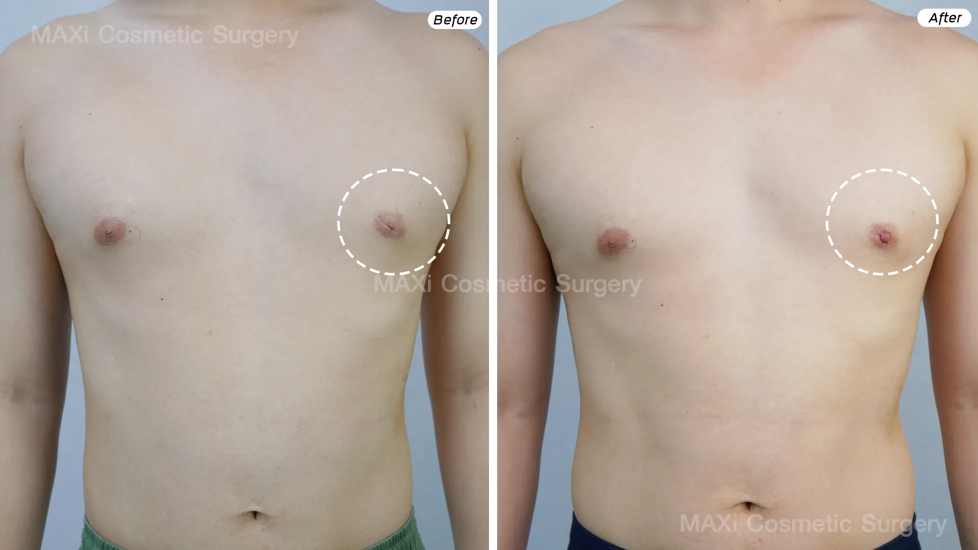 ภาพหลังผ่าตัดหัวนมบอดในผู้ชาย หัวนมโผล่ชัดเจน