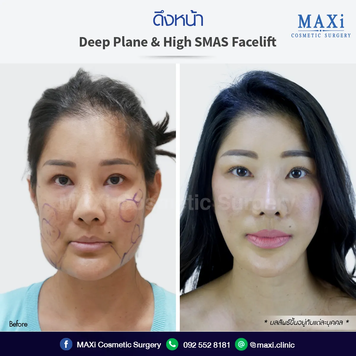 Before After ศัลยกรรมดึงหน้าหมอไหนดี ดึงที่ไหนดีผลลัพธ์ชัดเจนเป็นธรรมชาติ