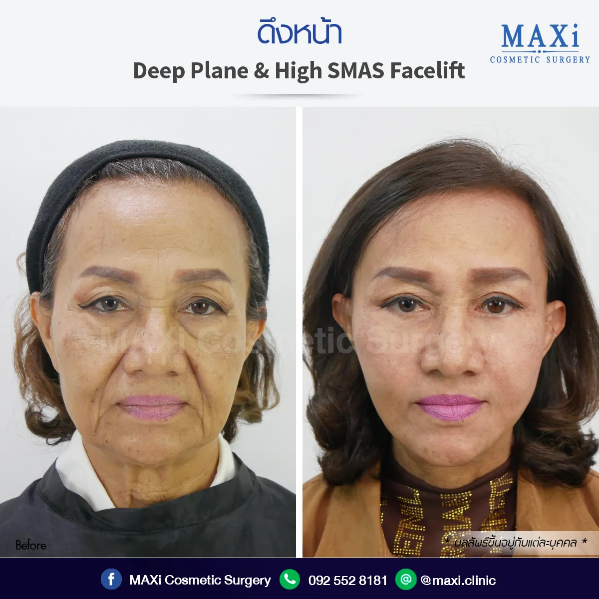 ดึงหน้าหมอไหนดี รีวิวผลลัพธ์จริง ใบหน้าเต่งตึง ดึงหน้าที่ไหนดีเห็นผลทันที