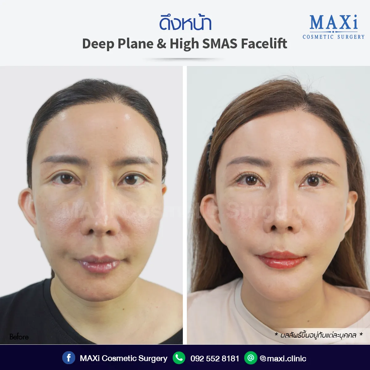 ผลลัพธ์จริงจากคนไข้ ดึงหน้า Face Lift หมอไหนดี ดึงหน้าที่ไหนดี กรุงเทพ