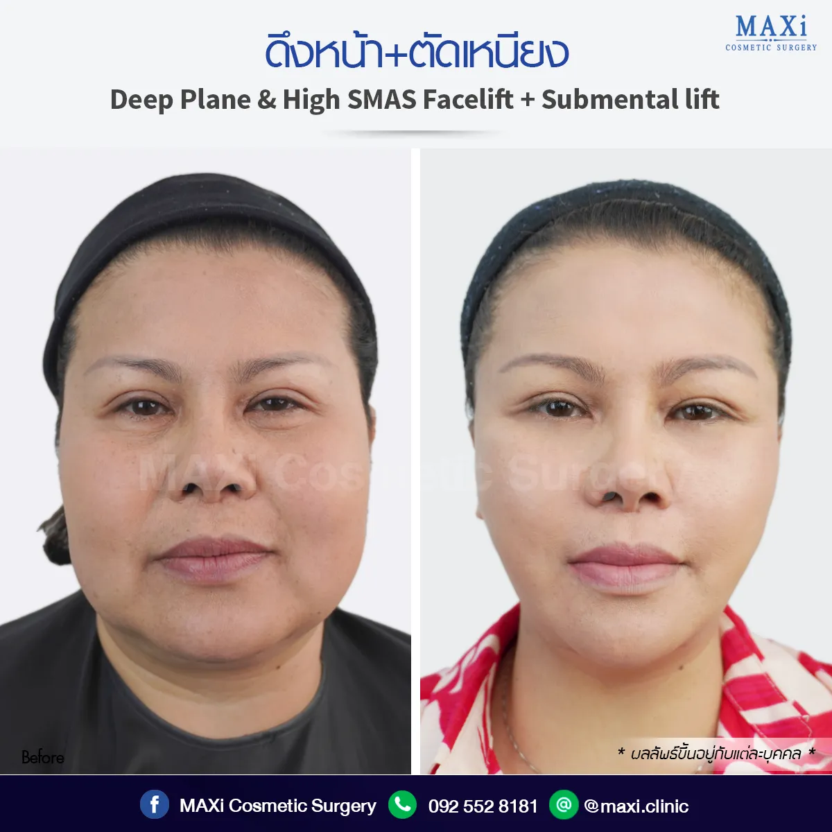 รีวิวดึงหน้าที่ไหนดี ดึงหน้าหมอเทคนิค Deep Plane ดึงหน้าตัดเหนียง ผลลัพธ์ใบหน้าเด็กลง