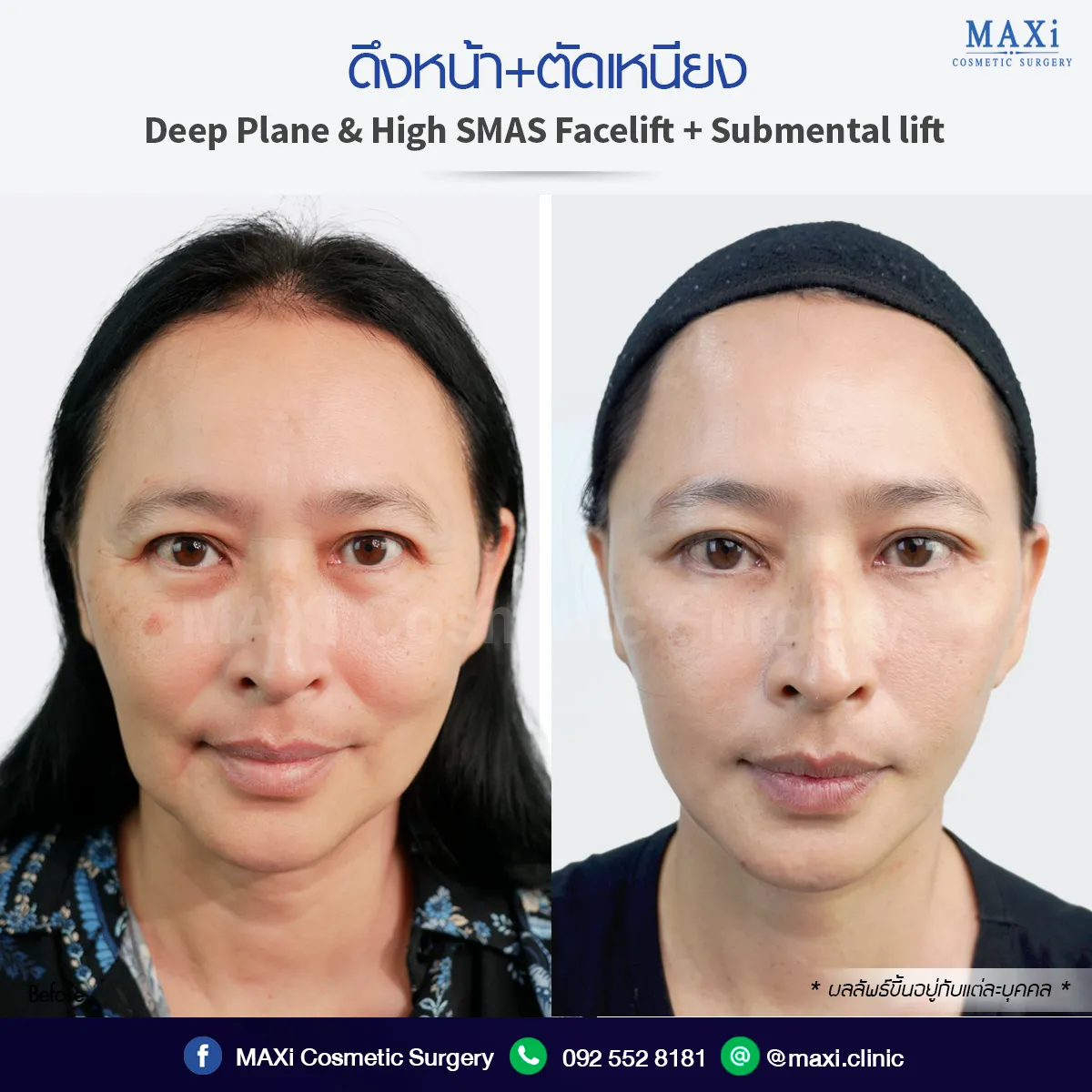 ดึงหน้าหมอไหนดี ดึงหน้าตัดเหนียง รีวิวคนไข้จริง ยกแก้ม กระชับกรอบหน้า
