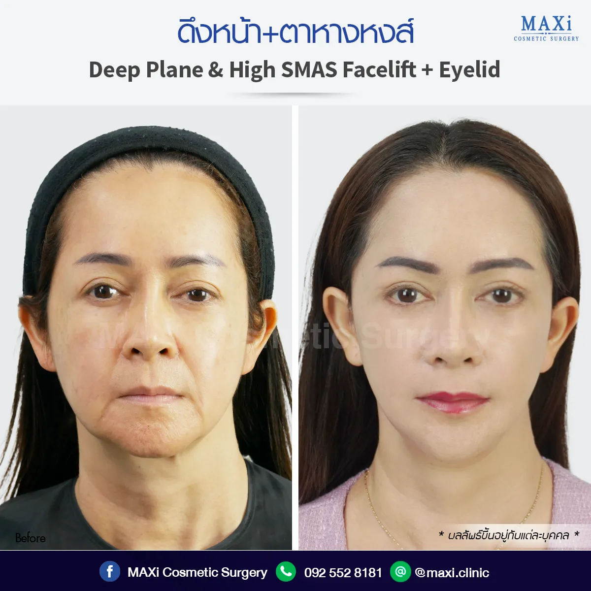 ภาพรีวิวดึงหน้าตาบนตาล่าง ก่อนหลัง ปรับรูปหน้า ยกหางตา หน้าเด็กลง ดึงหน้าที่หมอคณิต
