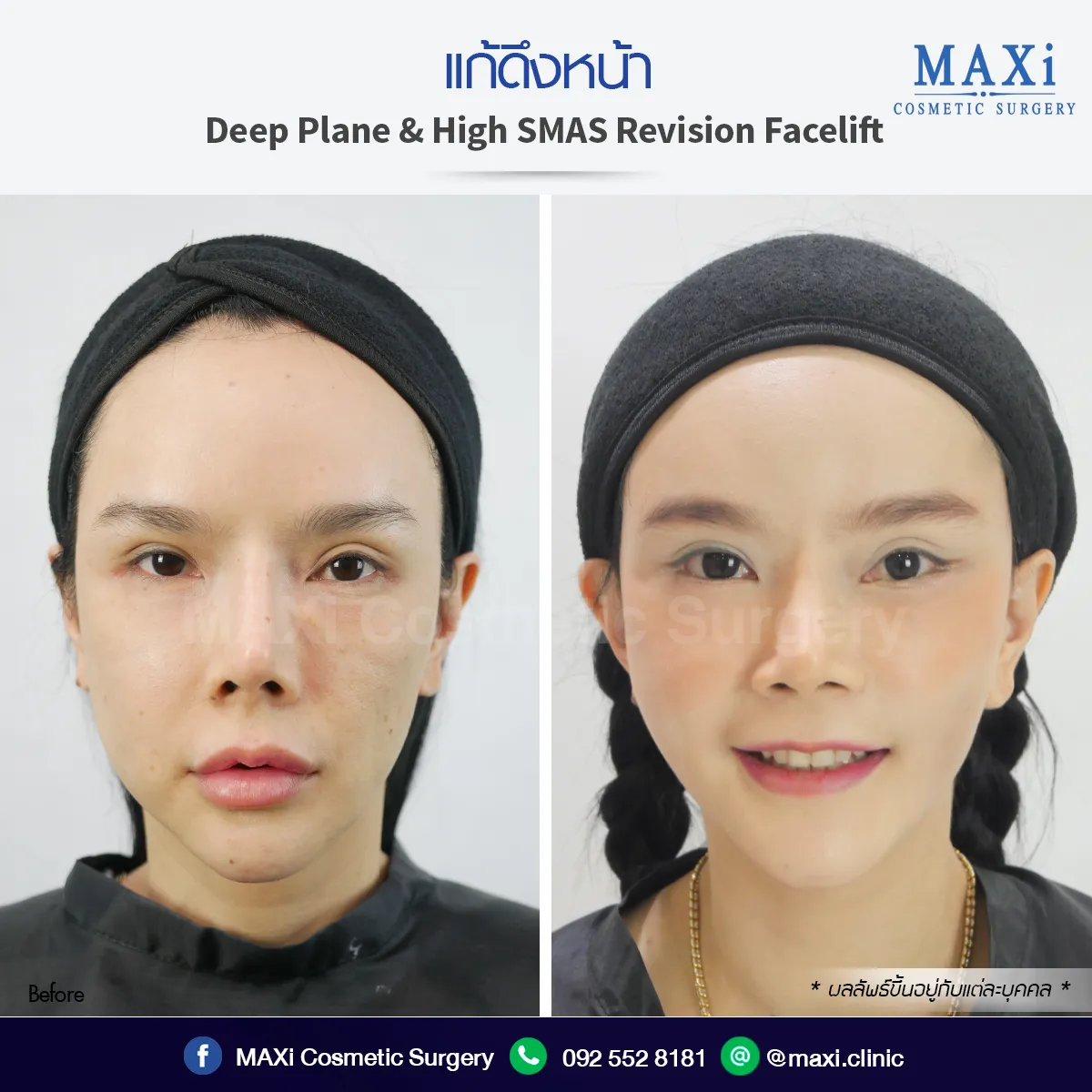 รีวิวก่อนหลัง ดึงหน้าที่ไหนดี ใบหน้ากระชับ ดูอ่อนเยาว์ขึ้น