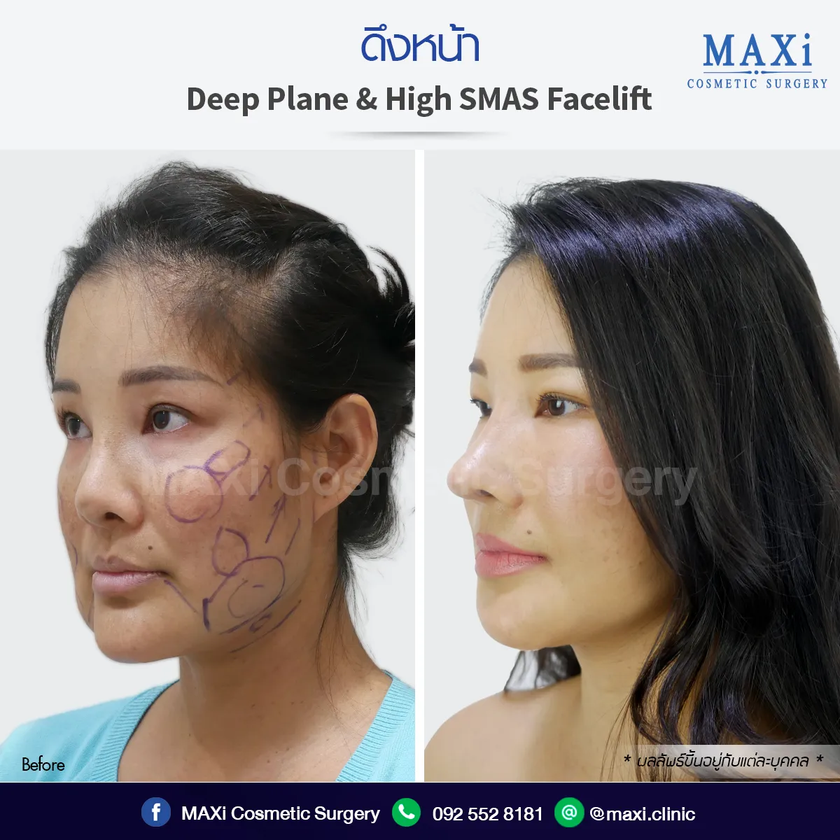 Before After ดึงหน้าที่ไหนดี ดึงหน้าหมอคณิต ลดเหนียง ลดแก้มตอบผลลัพธ์ชัด