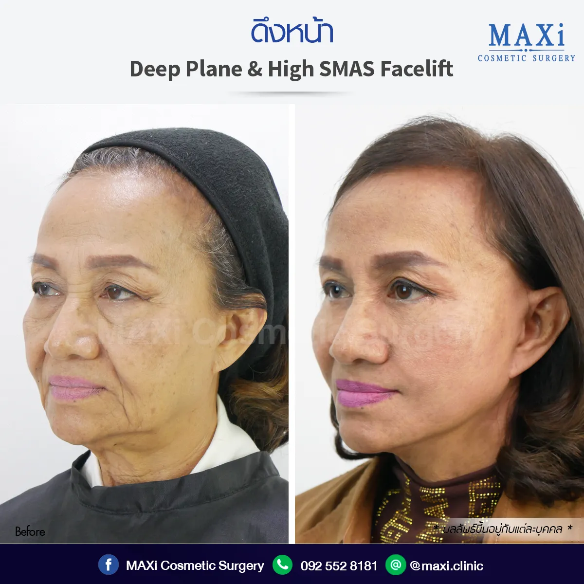 รีวิวดึงหน้าที่ไหนดี ดึงหน้าหมอคณิต Before After ยกกระชับผิวหน้า ดูเป็นธรรมชาติ
