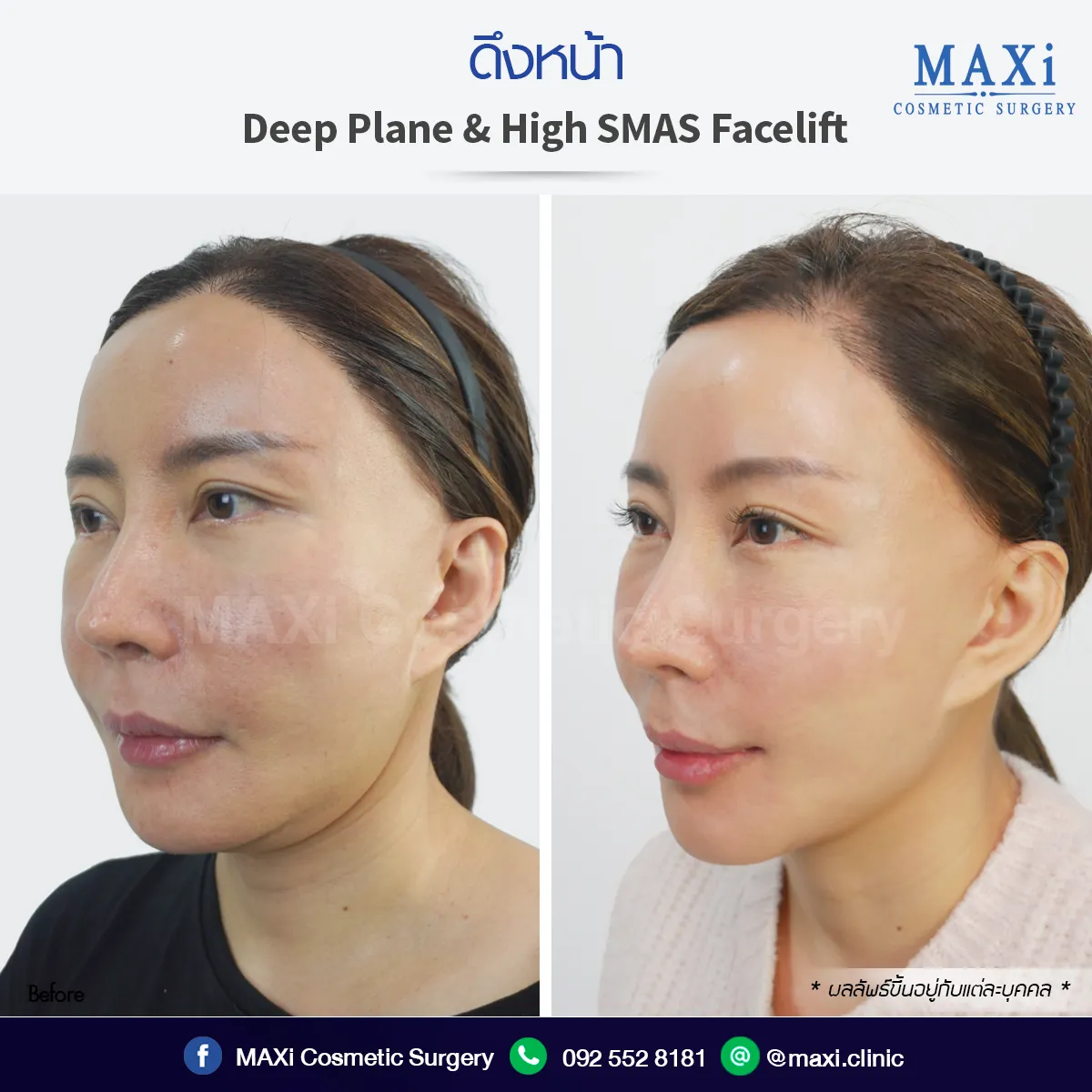 รีวิว Before After ดึงหน้าที่ไหนดี ดึงหน้าหมอไหนดี เทคนิค SMAS โดยแพทย์เฉพาะทาง