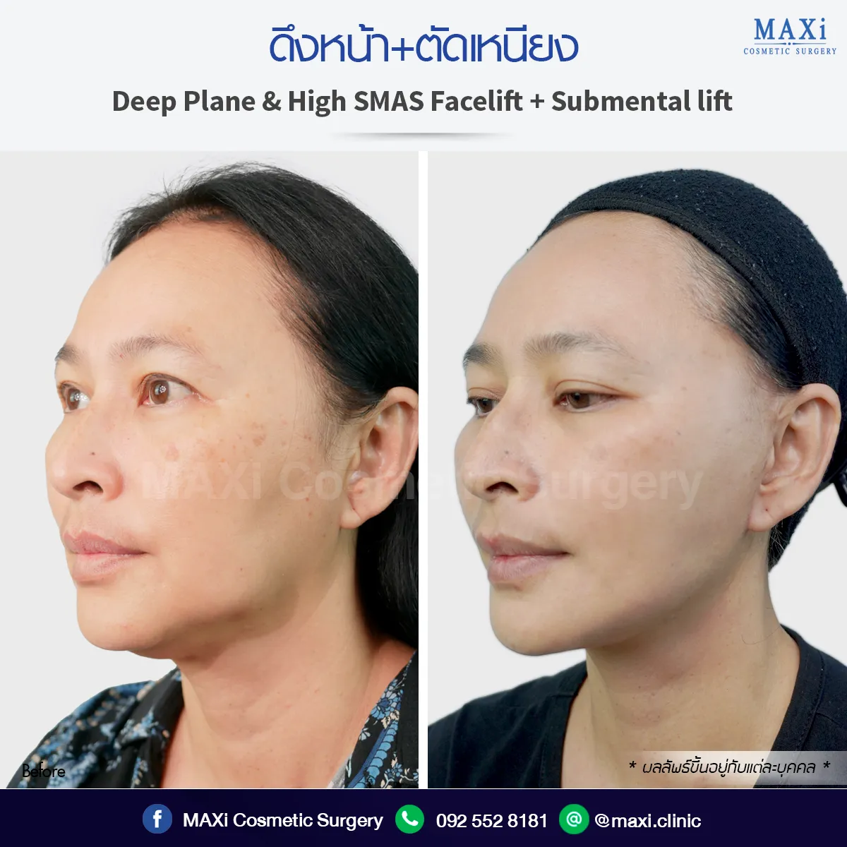 Before After ดึงหน้า Face Lift ดึงหน้าตัดเหนียง ย้อนวัย ลดร่องแก้ม ดึงหน้าที่ไหนดี ดึงหน้าหมอคณิต
