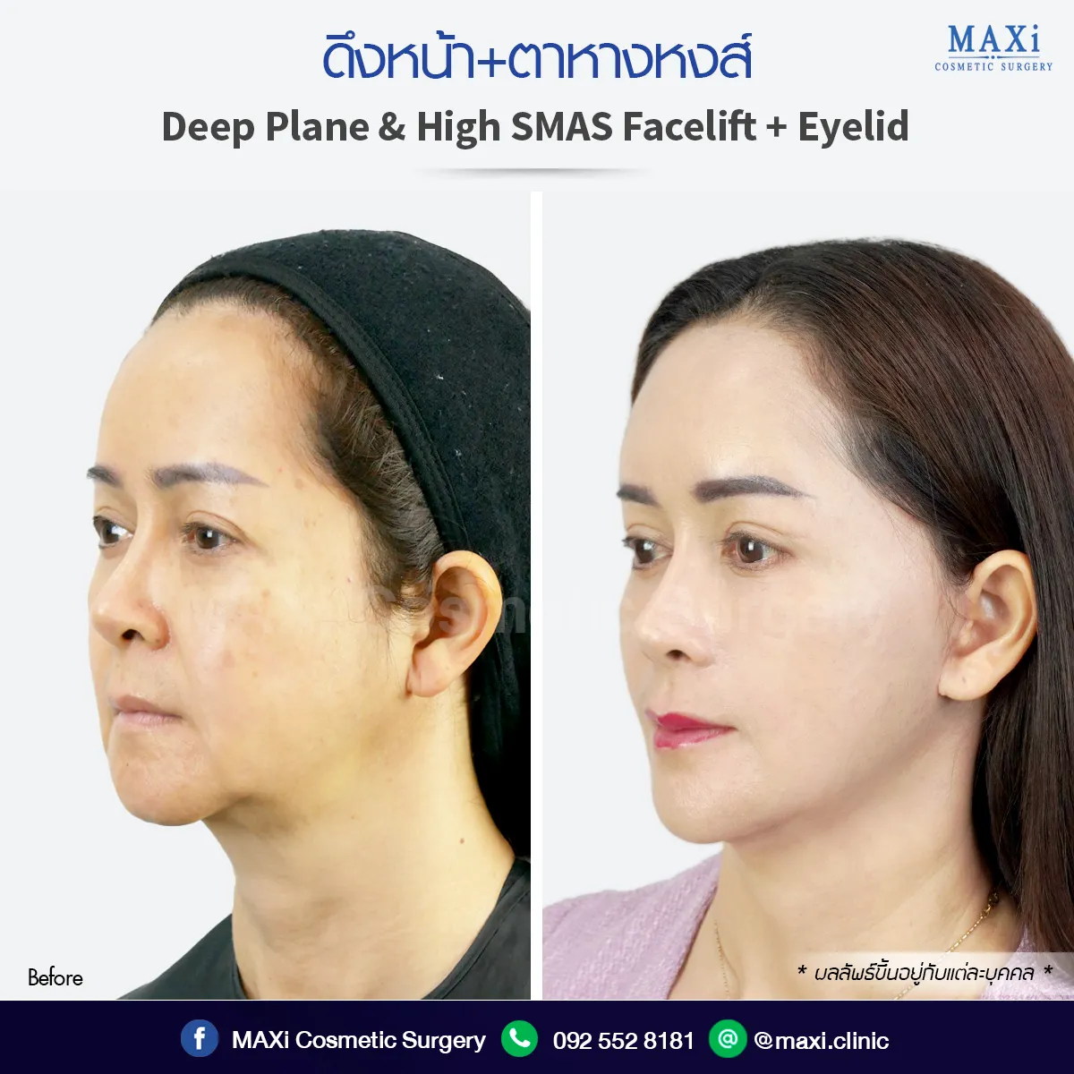 รีวิวดึงหน้าที่ไหนดี ดึงหน้าหมอไหนดีต้องหมอคณิต กรุงเทพ ใบหน้าตึงเรียว ดูอ่อนเยาว์