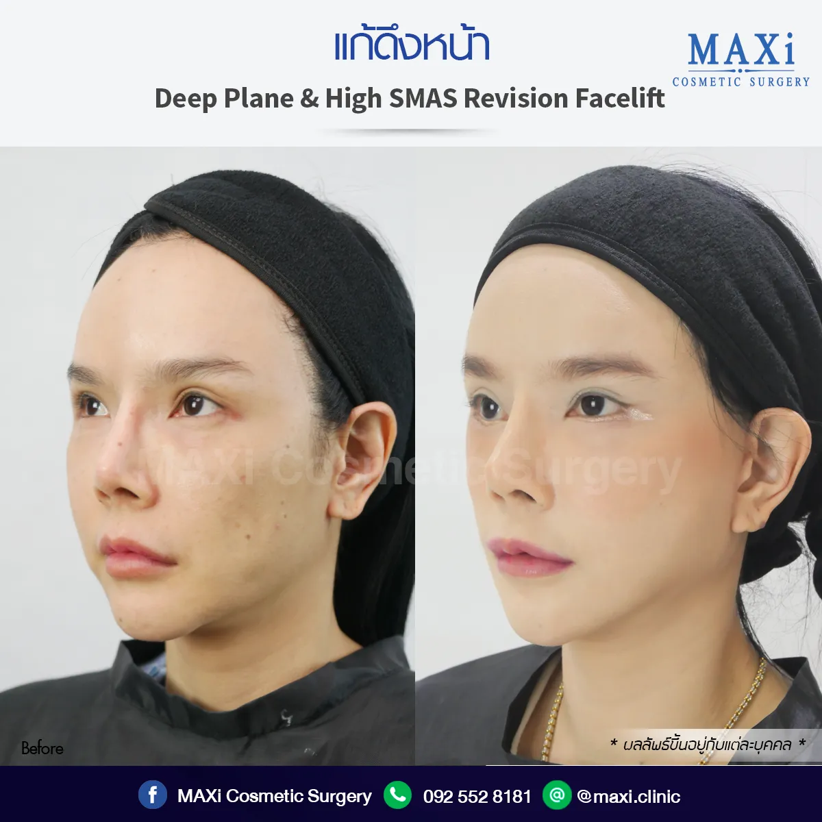 ดึงหน้าหมอไหนดี รีวิวดึงหน้าที่หมคณิต ผลลัพธ์จริง ใบหน้าเต่งตึง เห็นผลทันที