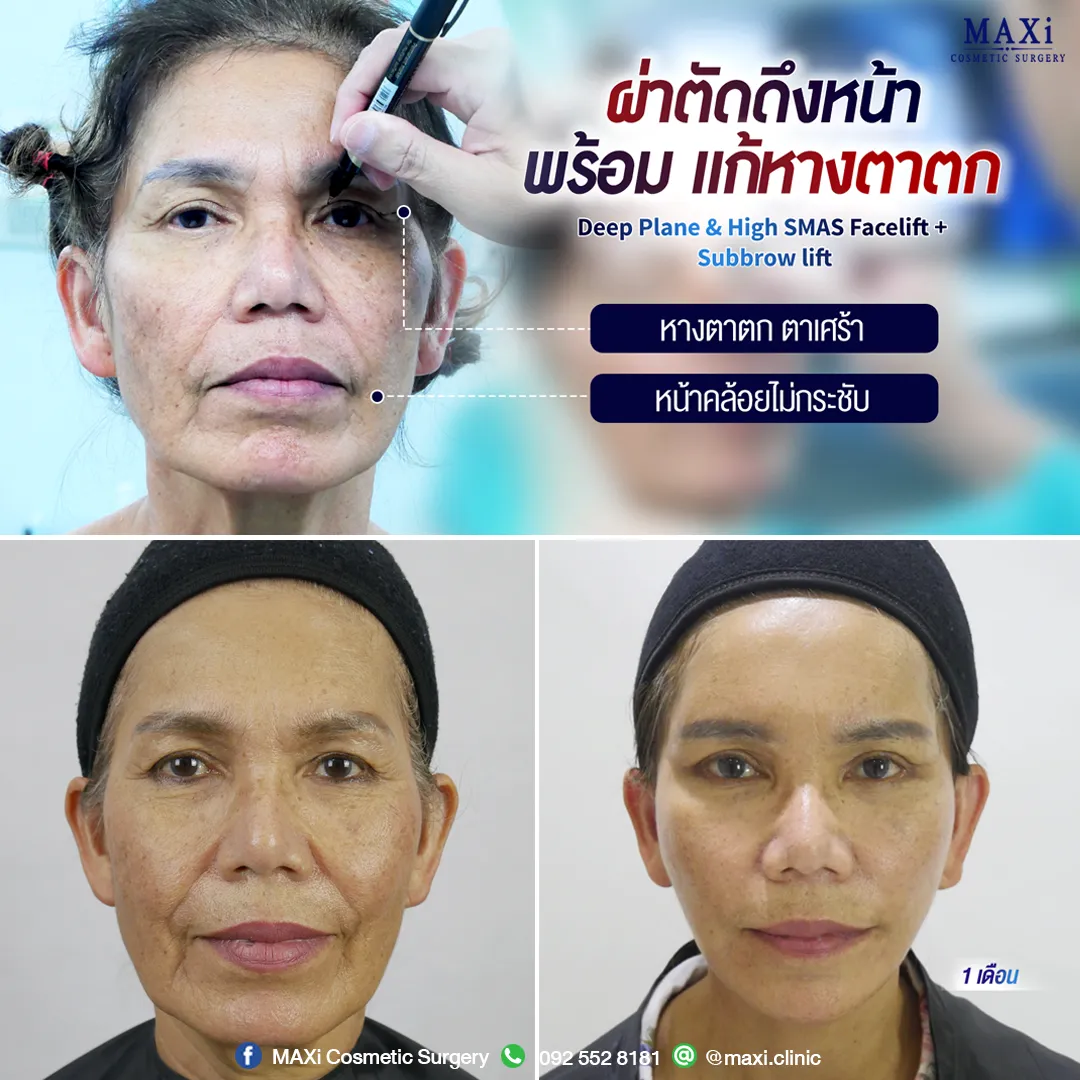รีวิว ดึงหน้าหมอไหนดี ผ่าตัดดึงหน้าที่ไหนดี ผ่าตัดดึงหน้าพร้อมแก้หางตาตก