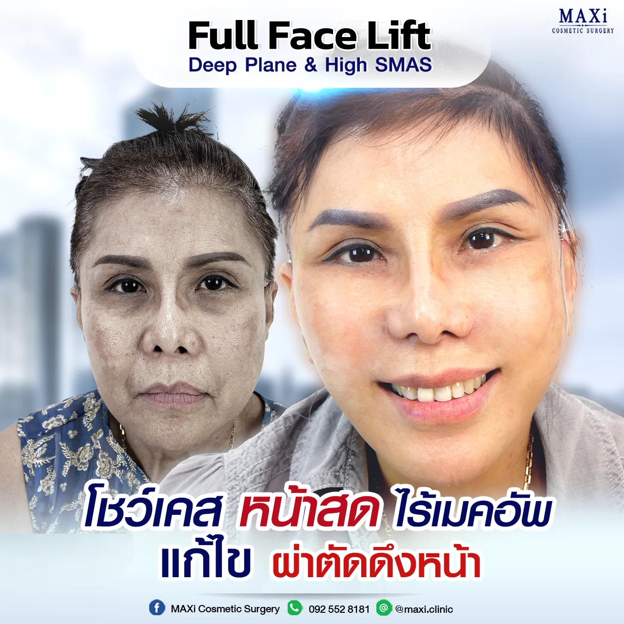 ดึงหน้าหมอไหนดี โชว์เคส ดึงหน้าที่ไหนดี หน้าสด ไร้เมคอัพหลังผ่าตัดดึงหน้า