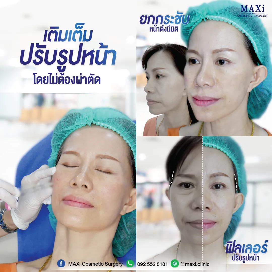 ผลลัพธ์หลังแก้หน้าคล้อย แก้ปัญหาผิวหย่อนคล้อย หน้าเรียวได้รูป ผู้หญิงวัย 40+ มีหน้าคล้อย ก่อนแก้หน้าคล้อยที่คลินิกศัลยกรรม