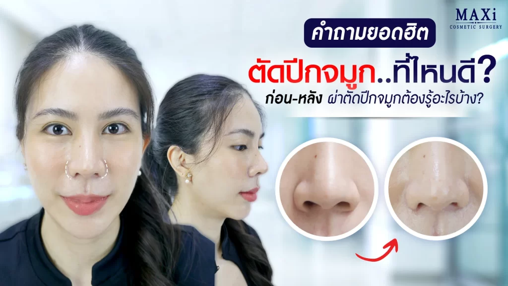 รวมคำถามยอดฮิตเกี่ยวกับการตัดปีกจมูก พร้อมตอบคำถาม ตัดปีกจมูกที่ไหนดี และแนะนำสิ่งที่ควรรู้ก่อน–หลังผ่าตัดตัดปีกจมูก