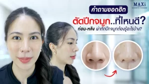 รวมคำถามยอดฮิตเกี่ยวกับการตัดปีกจมูก พร้อมตอบคำถาม ตัดปีกจมูกที่ไหนดี และแนะนำสิ่งที่ควรรู้ก่อน–หลังผ่าตัดตัดปีกจมูก