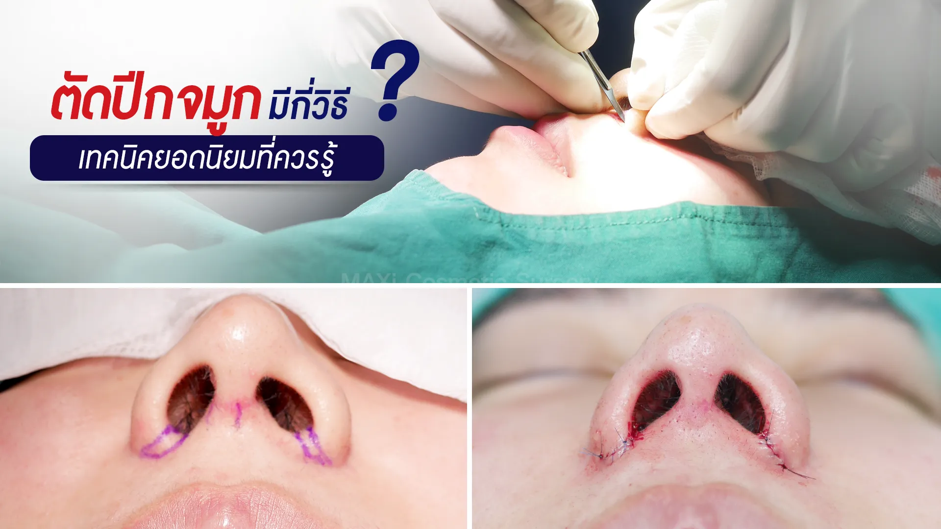 ภาพก่อนและหลังตัดปีกจมูกด้วยเทคนิคตัดปีกด้านใน แผลเล็ก ซ่อนรอยเย็บ เหมาะสำหรับผู้สนใจตัดปีกจมูกและต้องการผลลัพธ์ธรรมชาติ