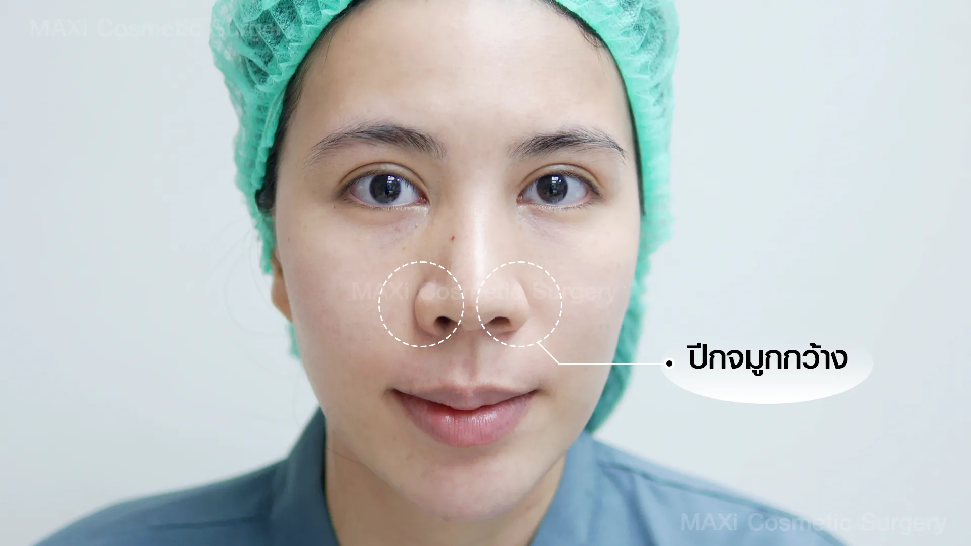 ภาพอธิบายวิธีตัดปีกจมูกแต่ละแบบ เทคนิคตัดปีกจมูกที่นิยม เช่น ตัดปีกด้านใน ตัดปีกด้านนอก และการเย็บซ่อนแผล เหมาะสำหรับผู้กำลังหาข้อมูลตัดปีกจมูกที่ไหนดี