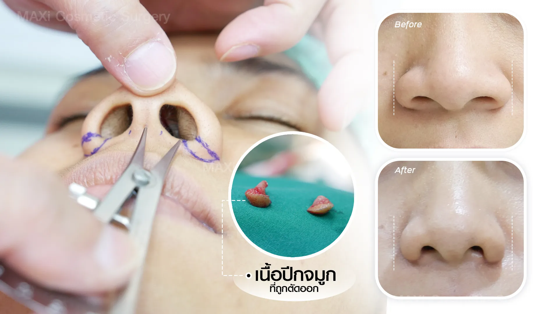 ภาพ Before–After ตัดปีกจมูก เทคนิคเย็บซ่อนแผลข้างใน ปีกจมูกแคบลงสวยงาม เหมาะสำหรับผู้ที่กำลังหาข้อมูลตัดปีกจมูกที่ไหนดี ให้ผลลัพธ์ดูธรรมชาติ