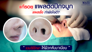 ผลลัพธ์ก่อนและหลังแก้รอยแผลตัดปีกจมูกด้วยเทคนิคแพทย์ผู้เชี่ยวชาญ
