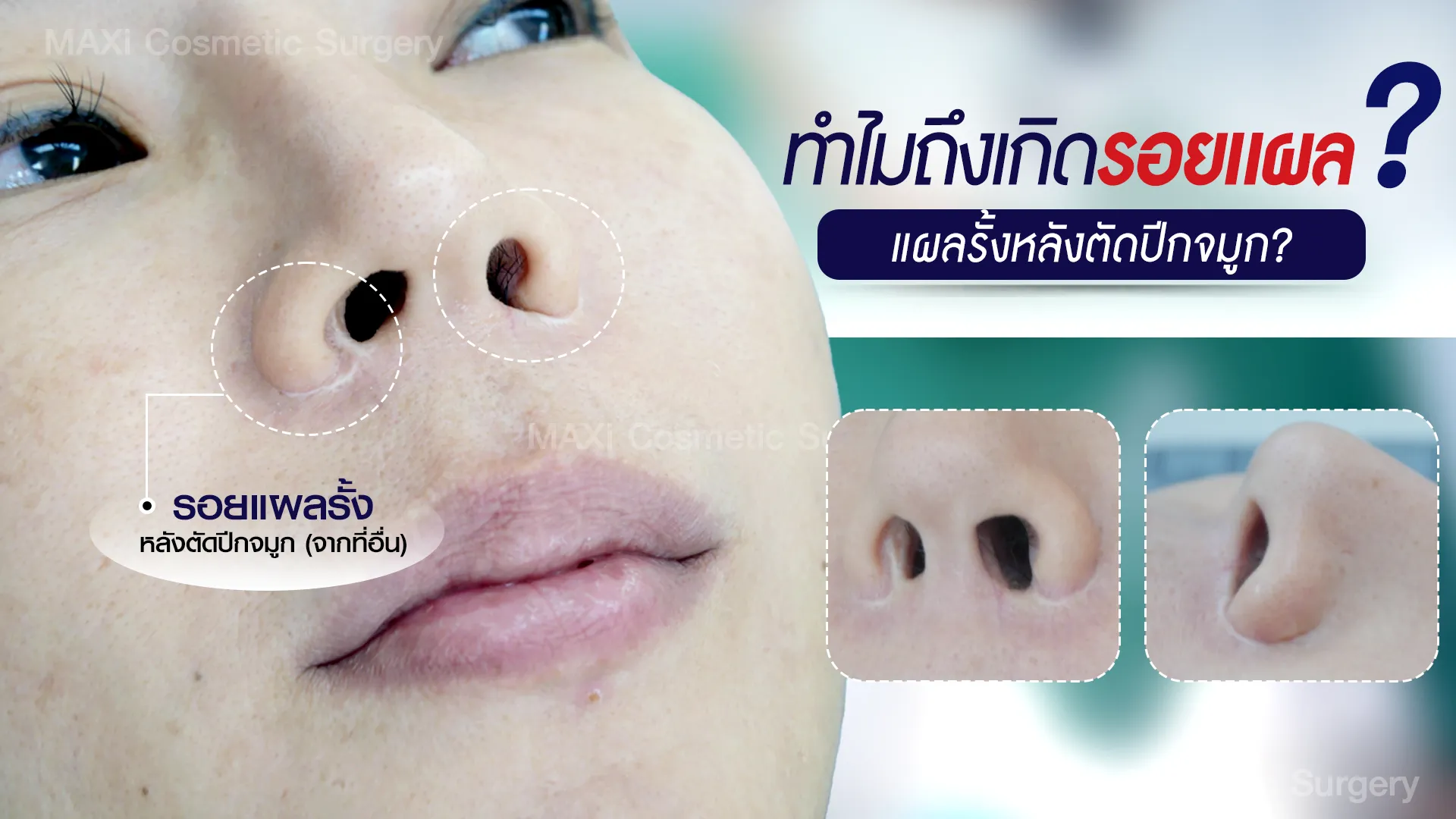 ภาพคนไข้หลังแก้รอยแผลตัดปีกจมูก พร้อมผิวที่ดูเนียนและเป็นธรรมชาติ