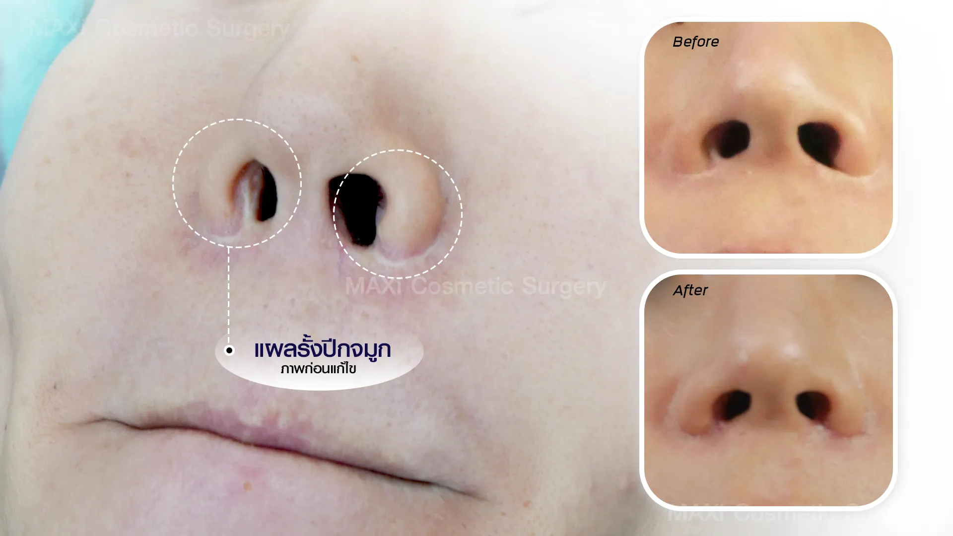 ภาพเปรียบเทียบก่อน–หลังแก้แผลรั้งปีกจมูกให้ได้รูปสวยเป็นธรรมชาติ