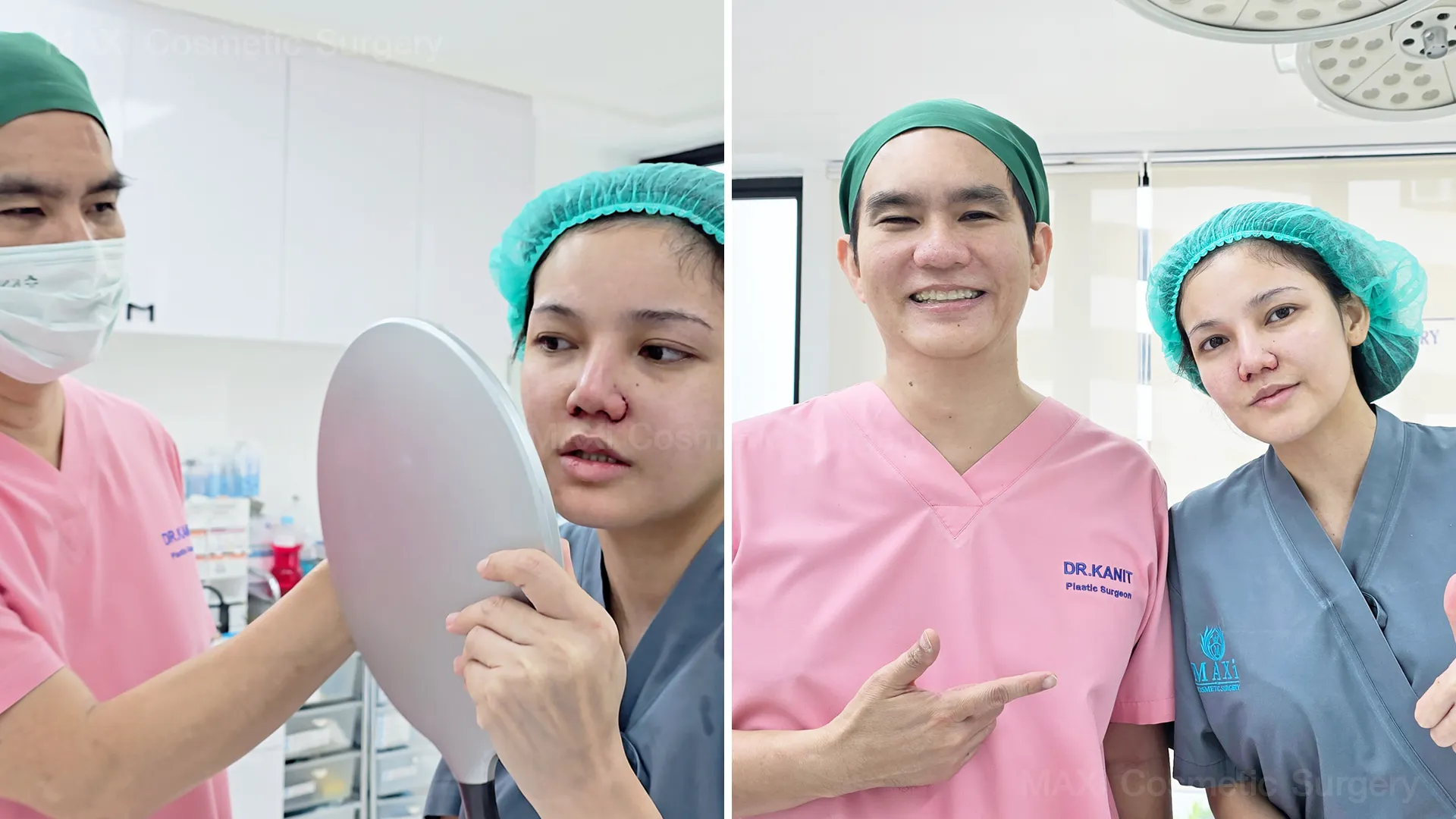 ภาพเปรียบเทียบก่อนและหลังตัดปีกจมูก เทคนิคแผลเล็กฟื้นตัวไว เห็นผลลัพธ์ที่เป็นธรรมชาติ เหมาะสำหรับผู้ที่กำลังหาข้อมูลตัดปีกจมูกที่ไหนดี