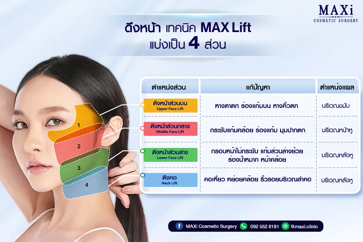 ดึงหน้า แก้หน้าคล้อย ด้วยเทคนิคดึงหน้า 4 ส่วน