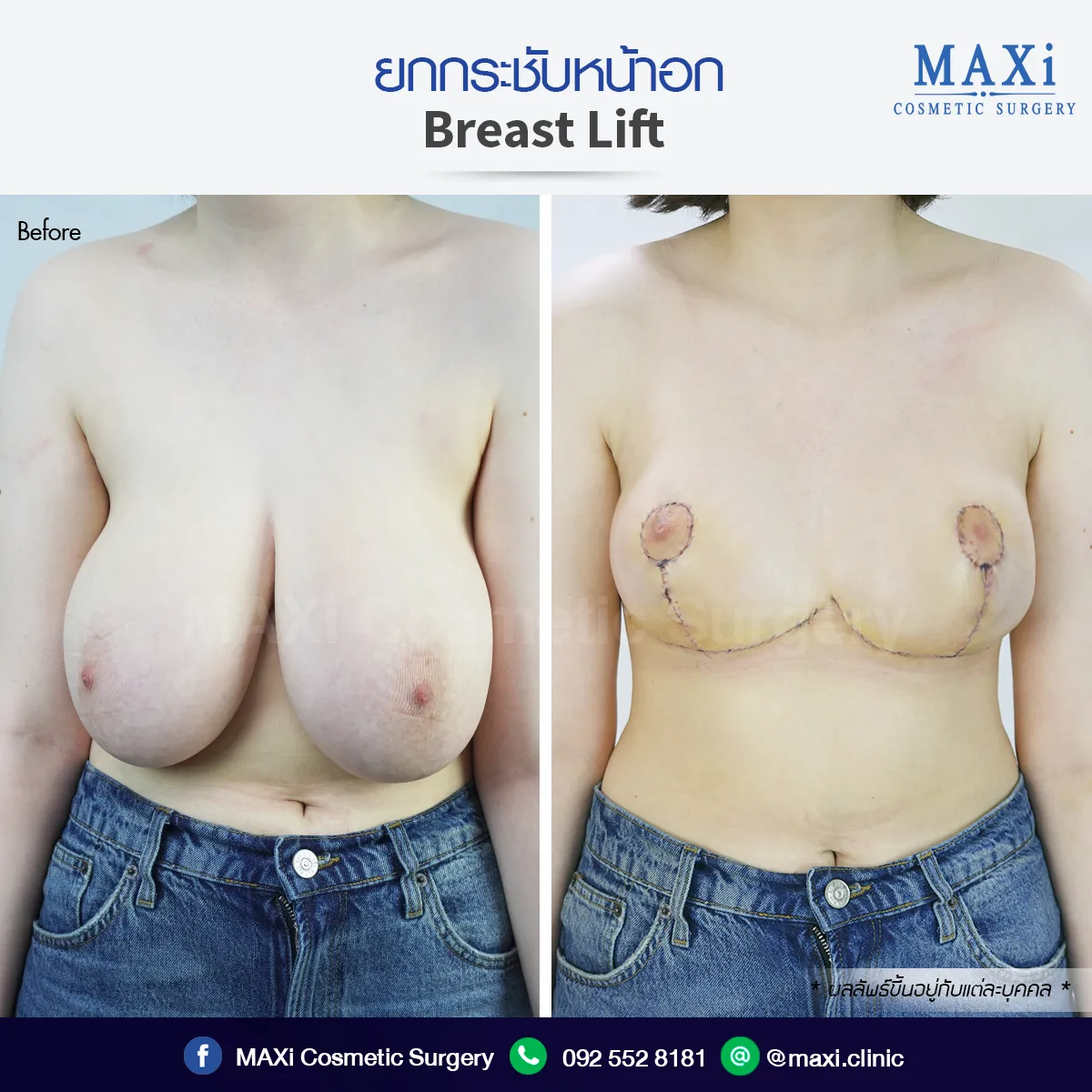 รีวิวก่อนและหลังเสริมหน้าอก ผลลัพธ์หน้าอกอวบอิ่ม ดูสวยมั่นใจมากขึ้น