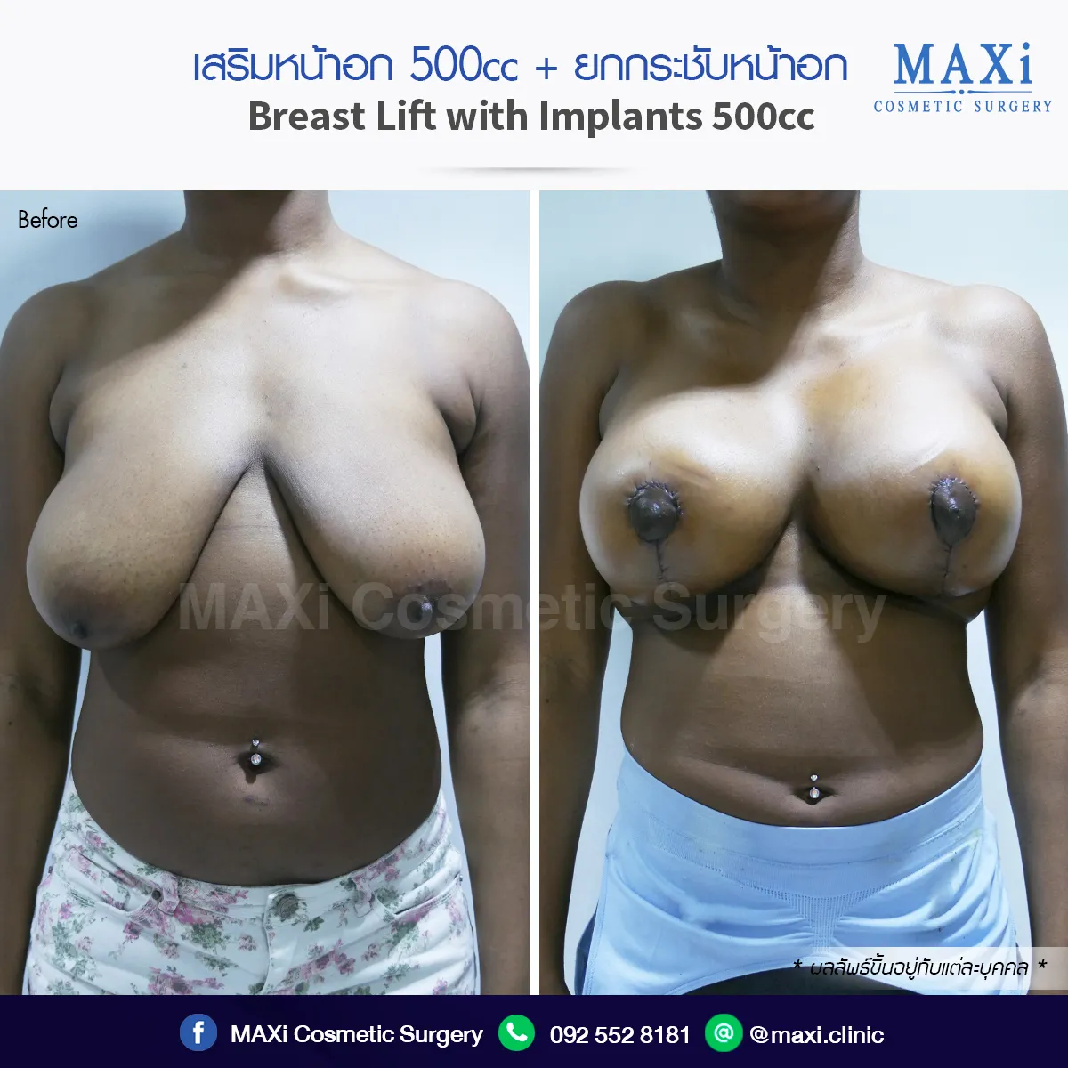 ภาพก่อนและหลังเสริมหน้าอกและยกกระชับหน้าอก เพิ่มความมั่นใจและความเป็นตัวเอง