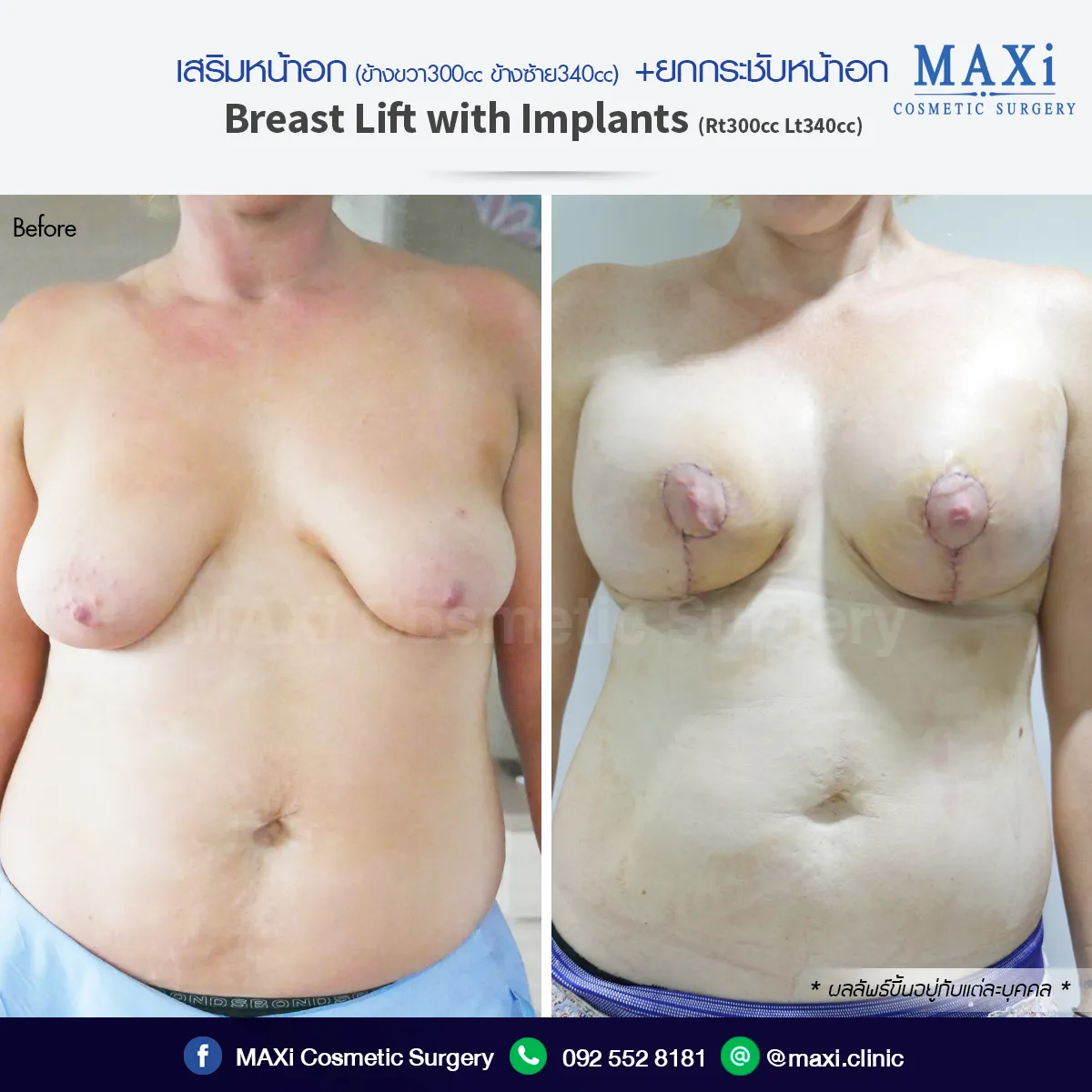 ภาพก่อนและหลังเสริมหน้าอก ผลลัพธ์หน้าอกอวบอิ่มทรงสวยเป็นธรรมชาติ
